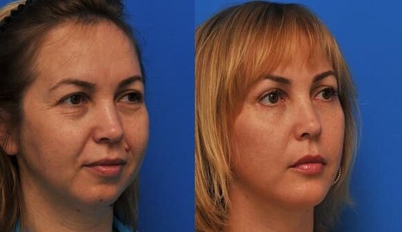 قبل و بعد از جوانسازی پوست با سفت کردن عکس 1