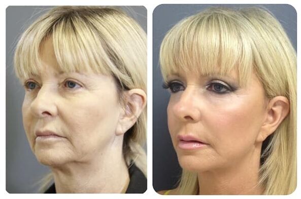 قبل و بعد از جوانسازی پوست با سفت کردن عکس 2