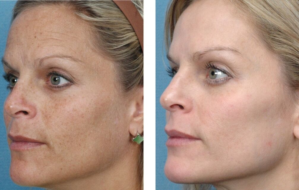 قبل و بعد از جوانسازی پوست