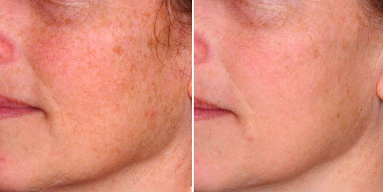 نتیجه فتوترمولیز فراکشنال کاهش لکه های پیری روی پوست صورت است. 